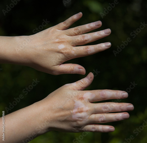 Hand with vitiligo skin condition