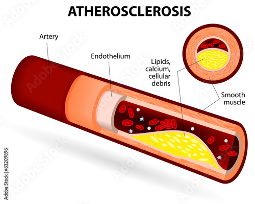 Atherosclerosis