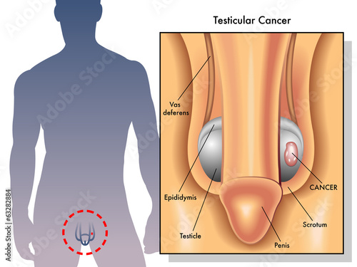 cancro del testicolo