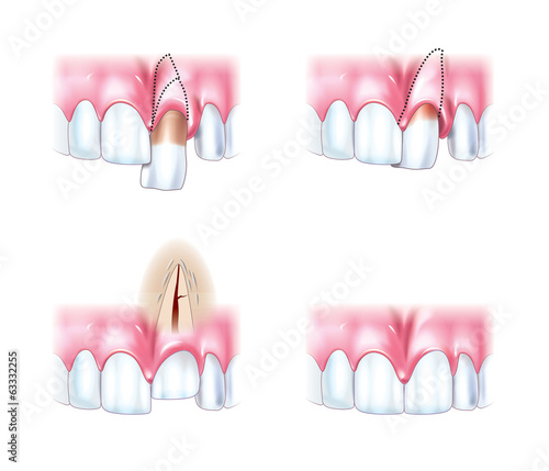 Slika na platnu Scheme dislocations teeth