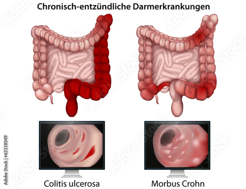 Chronisch - entzündliche Darmerkrankungen,betroffene Regionen photo