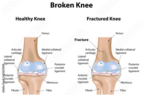 Broken Knee