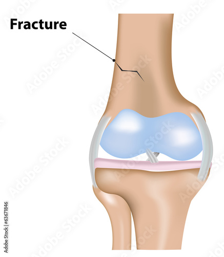 Fractured Leg