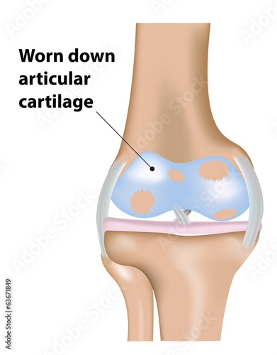 Osteoarthritis of the Knee Joint photo