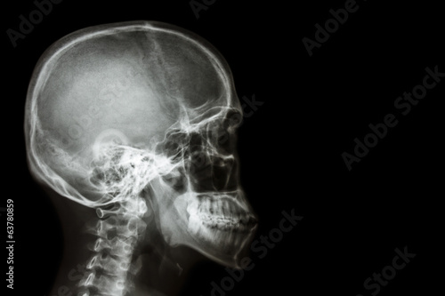 X-ray asian skull (Thai people) and blank area at right side