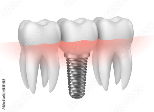 Prothèse dentaire vectorielle 1