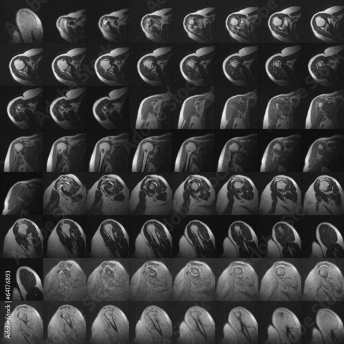 MRI of humerus