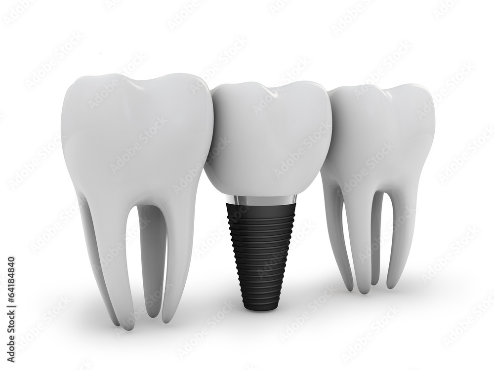 tooth implant tooth implant