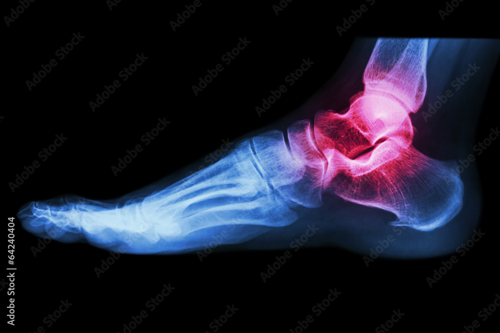 X-ray human's ankle with arthritis