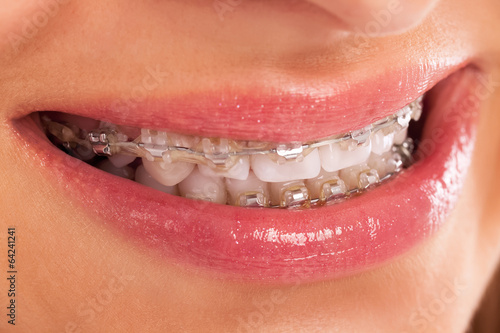 Detail of young womans smile showing white teeth with braces