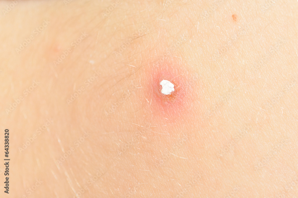 Fototapeta premium chickenpox