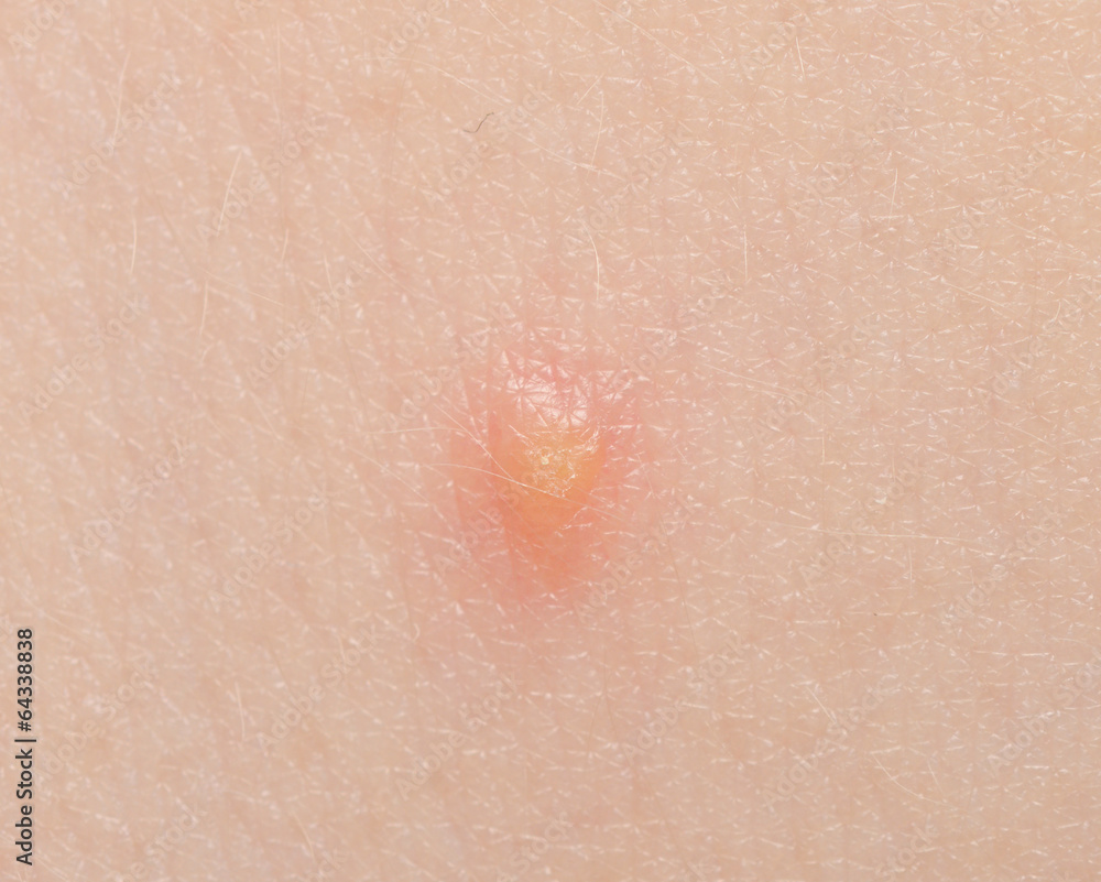 Fototapeta premium chickenpox