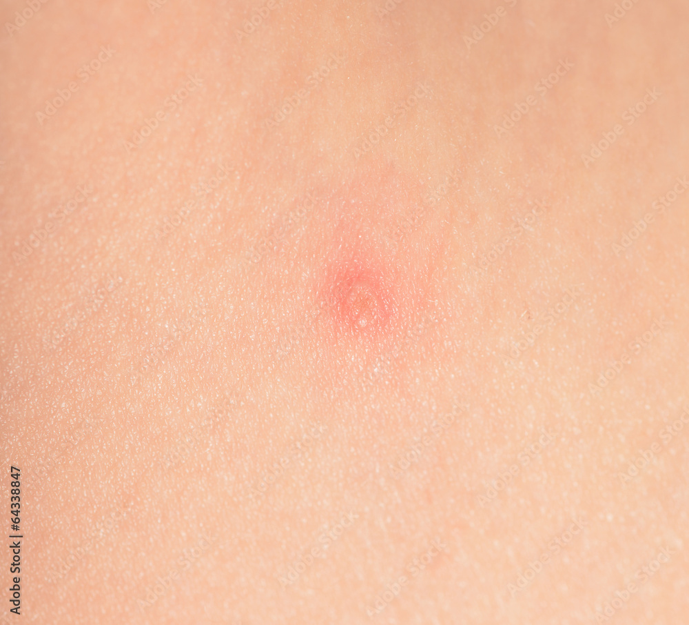 Fototapeta premium acnes sur l'enfant. varicelle