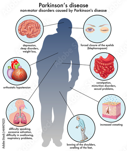 effetti collaterali del Morbo di Parkinson
