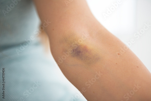 Closeup on bruise hand of drug addict young woman photo