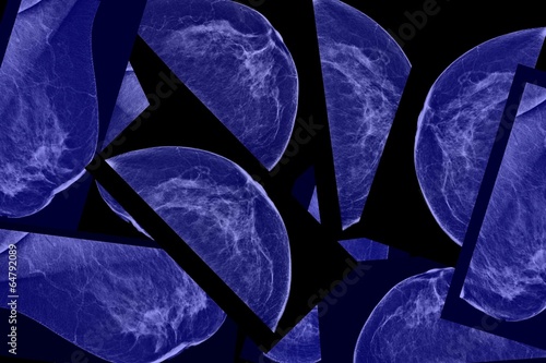 Φωτογραφία Lateral mammogram of female breast