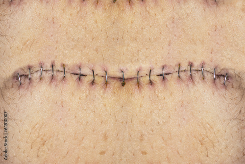 Fotografia Stitches on belly