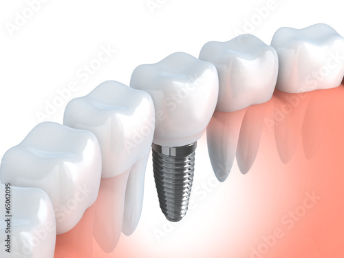 Dental implant #65062095
