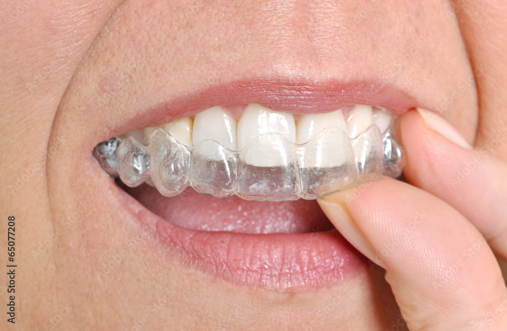 Fototapeta premium Invisible braces