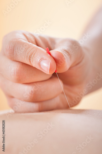 Acupuncturist Placing Needle On Man's Back In Spa