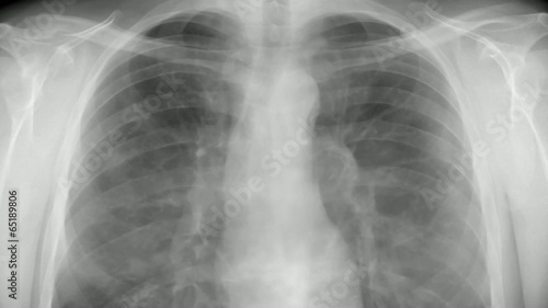 Chest x-ray - smoking. photo