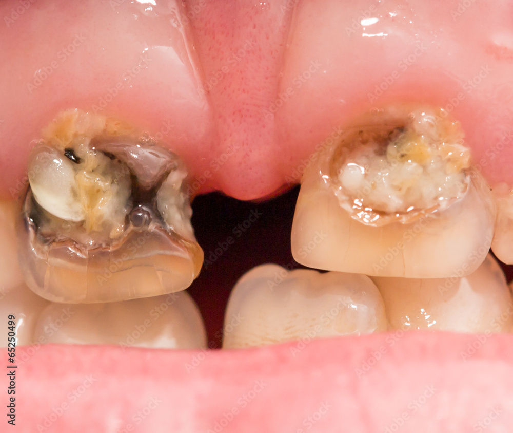 Obraz premium rotten teeth. macro