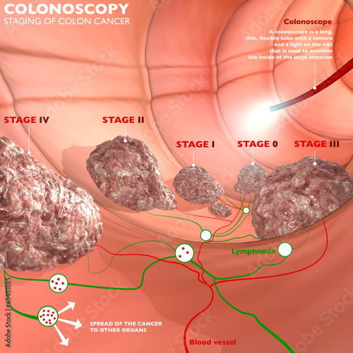 Colonscopia esame colon apparato digerente photo