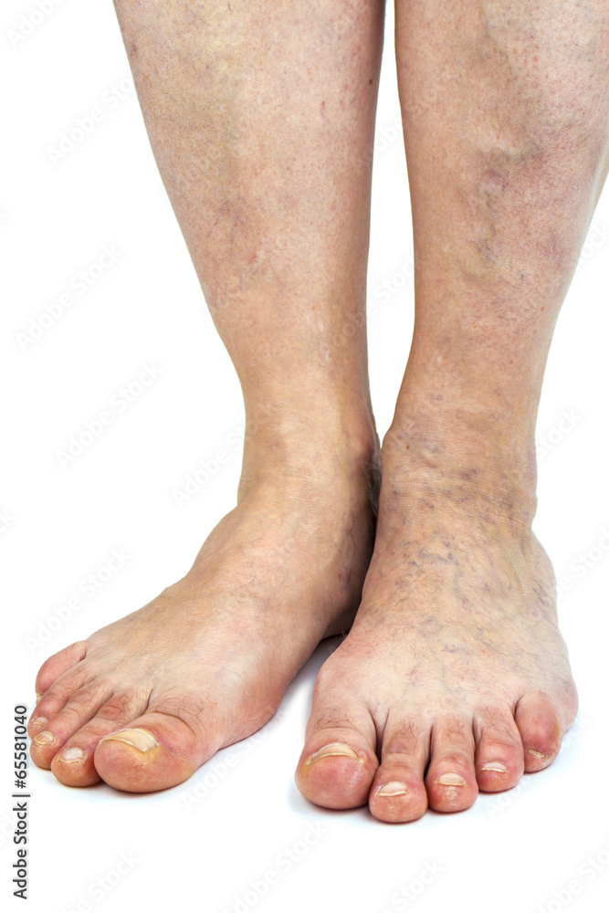 Varicose veins Varicose veins