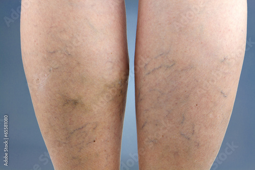 Photos Varicose veins
