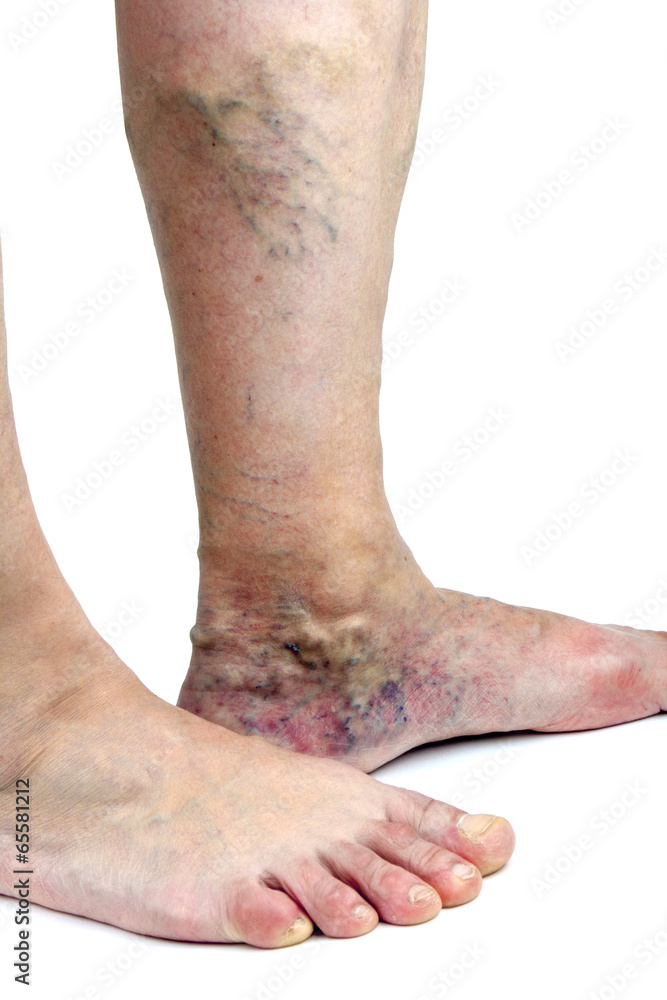 Varicose veins Varicose veins