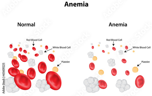 Принти на полотні Anemia Labeled Diagram
