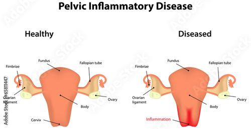 Pelvic Inflammatory Disease