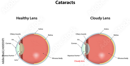Cataracts