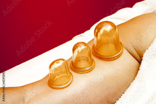 Anti cellulite massage Ventuza body pullers, close-up photo