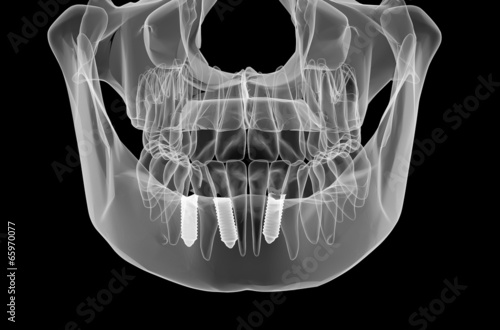 Dental implant and teeth