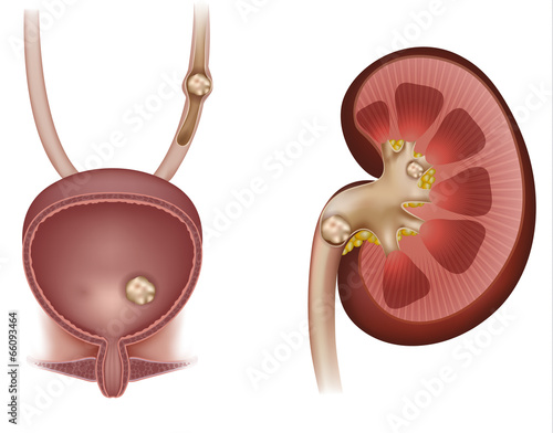 Stones in the kidney, urinary bladder and ureter