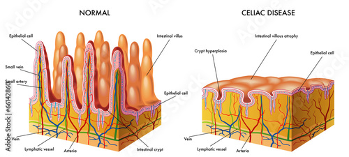 celiachia photo