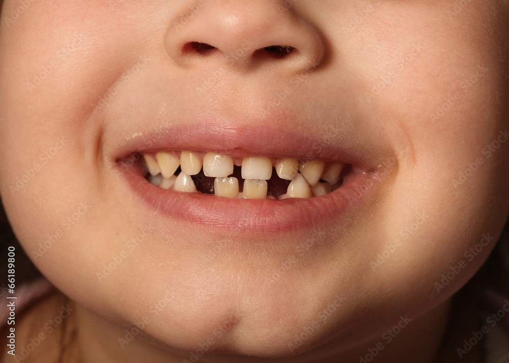 Obraz premium smiling child with baby teeth dropped out. Dental girls bite 