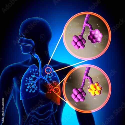 Pneumonia - Normal alveoli vs Pneumonia photo