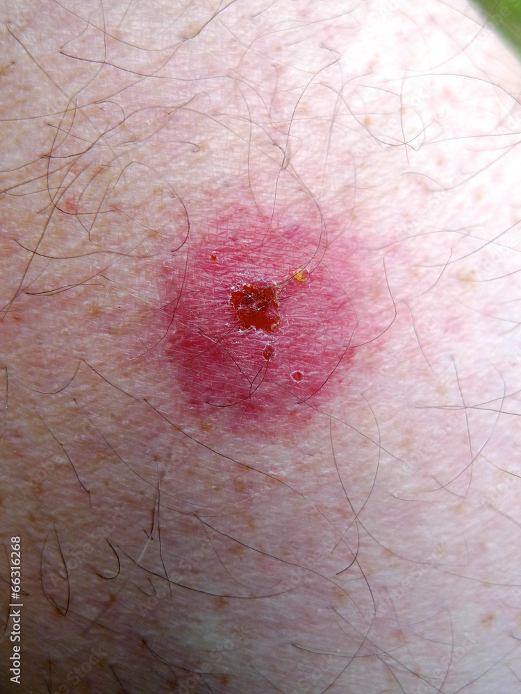 Schwellung nach Insektenstich StockFoto Adobe Stock