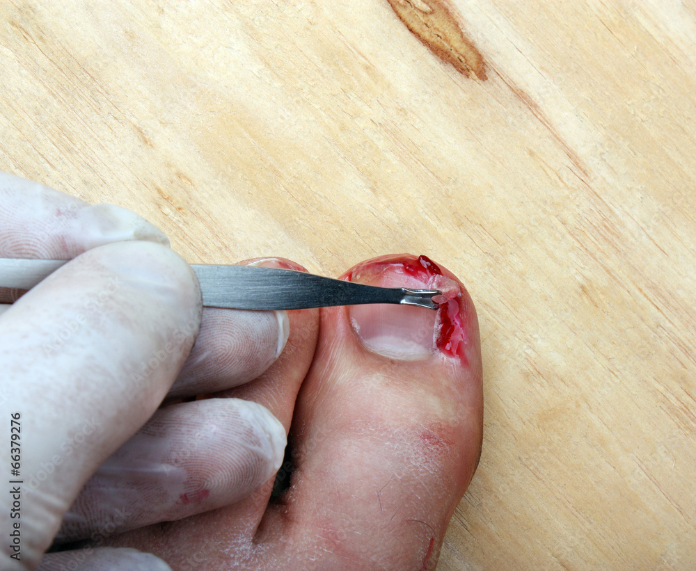 Cut Finger And Blood Stock Photos and Images - 123RF