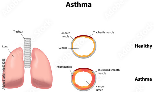 Asthma