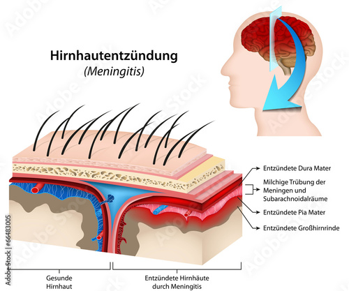 Meningitis, Hirnhautentzündung Illustration