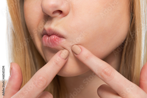 Tableau sur toile Closeup on teenager poping pimple