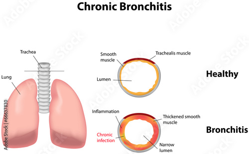 Chronic Bronchitis