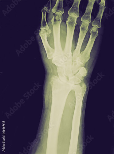 Retro look Xray of epiphysial radial fracture reduced with perma photo