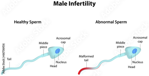 Male Infertility