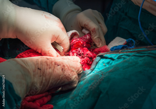 Photography total thyroidectomy