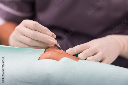 puncture  radial artery for arterial line monitor