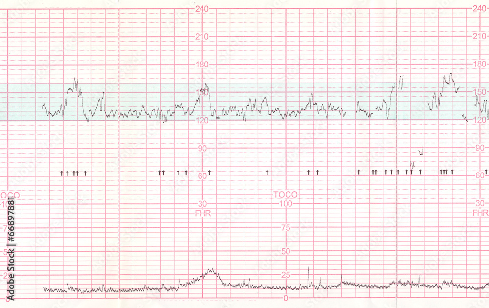 EKG or ECG result
